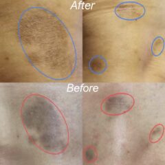 撃退！　加齢による　黒ずみ！　