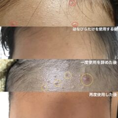 思春期ニキビにも”はなびらだけ石鹼”