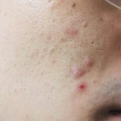 にきび　かぶれ　清潔感を大切にするあなた試してみてください。