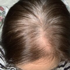 薄毛　分け目が気になる　でお悩みの方　必見です！