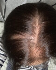 分け目の薄い女性②