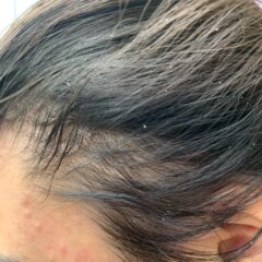 抜け毛　薄毛　育毛でお悩みの方　頭皮のかゆみについて解説