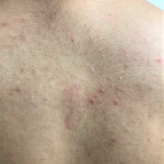 夏に向けて　背中ニキビを今から対策！