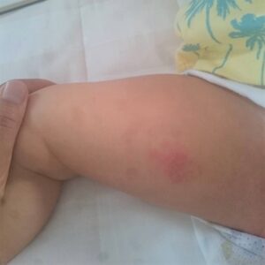 あせもかぶれのあかちゃんのもも