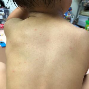 子供の背中にあせも2