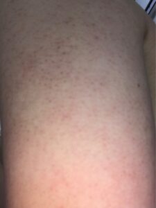 女性の二の腕ぷつぷつお肌