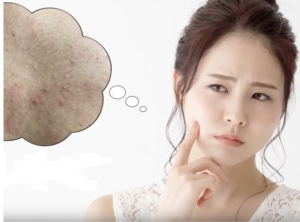 背中ニキビを悩む女性