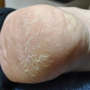 足のかかとの２日目